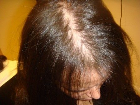 women's hair loss