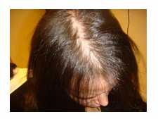 women's hair loss